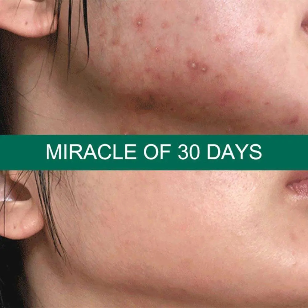 سرم لایه بردار و ضد جوش Miracle سام بای می 50 میل