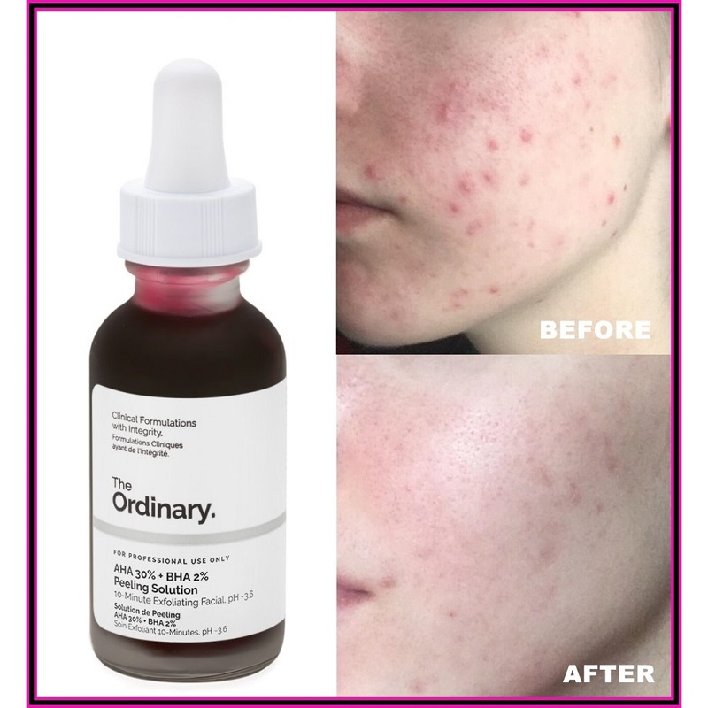 سرم پیلینگ AHA 30% + BHA 2% لایه بردار اوردینری 30 میل