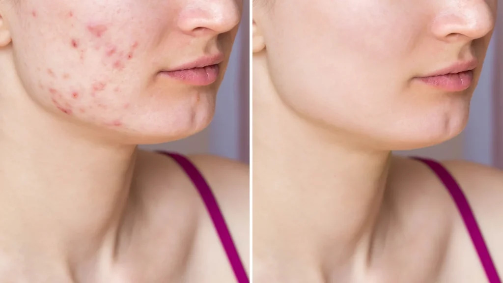 ژل ضد جوش دیفرین 30 میل