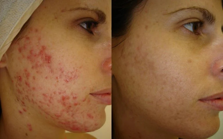 ژل ضد جوش دیفرین 30 میل