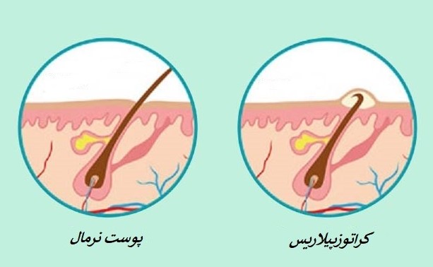 لوسیون لایه بردار کراپیل نوروا 75 میل
