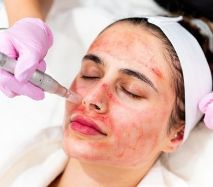 میکرونیدلینگ چیست و چه فوایدی برای جوان‌سازی پوست دارد؟